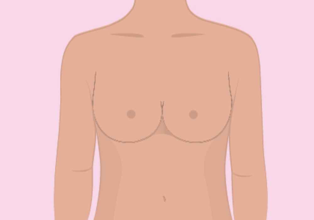 Kiểu ngực Close Set - Ngực sát