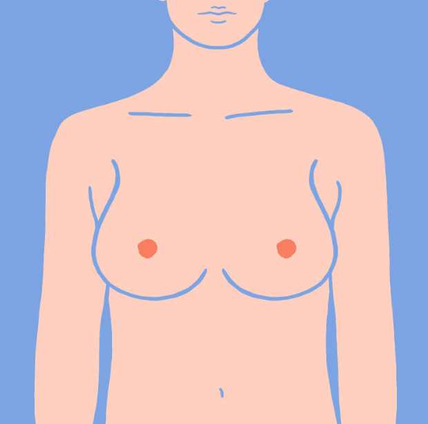 Kiểu ngực Bell Shape là gì